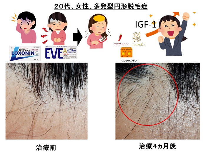 円形脱毛症　病院